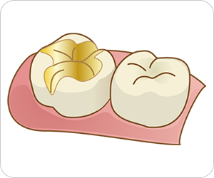 ゴールドインレー